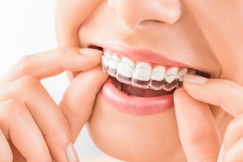 Things to Know Before Getting Invisalign