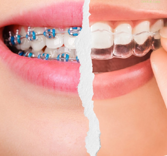 In this comprehensive guide, we provide invaluable tips from our experienced team to help you take the best care of your braces or Invisalign aligners.