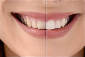 The Truth About Teeth Whitening
