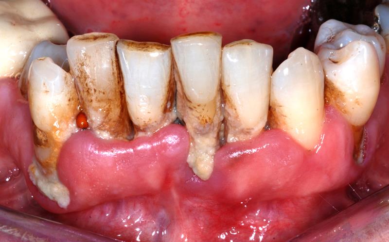 Post-Op Care for Root Canals