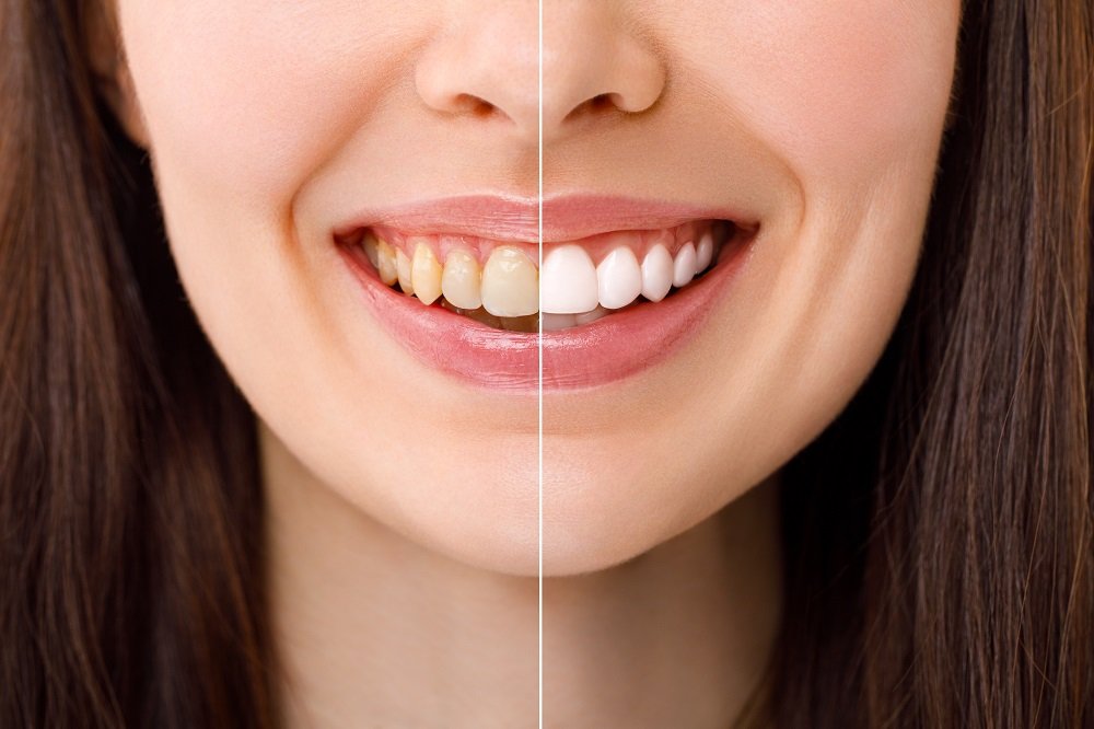 Professional Teeth Whitening: Achieve a Brighter, More Confident Smile