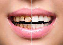 The Difference Between Teeth Scaling and Dental Cleaning