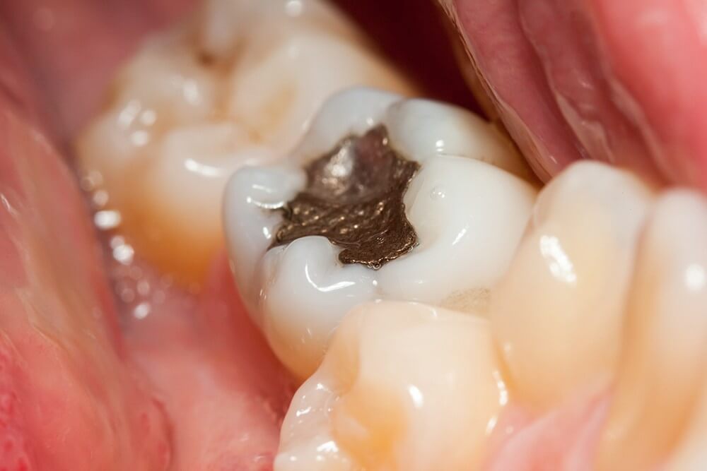How Sugar Causes Tooth Cavity?