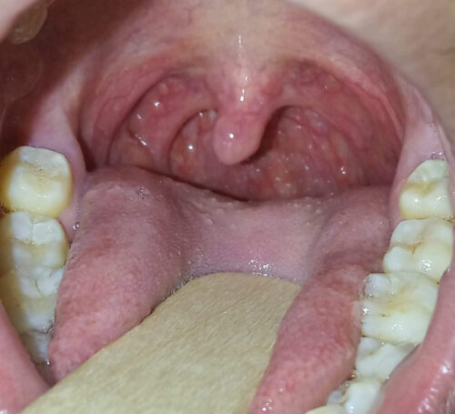 All About Tonsil Stones and How to Prevent Them