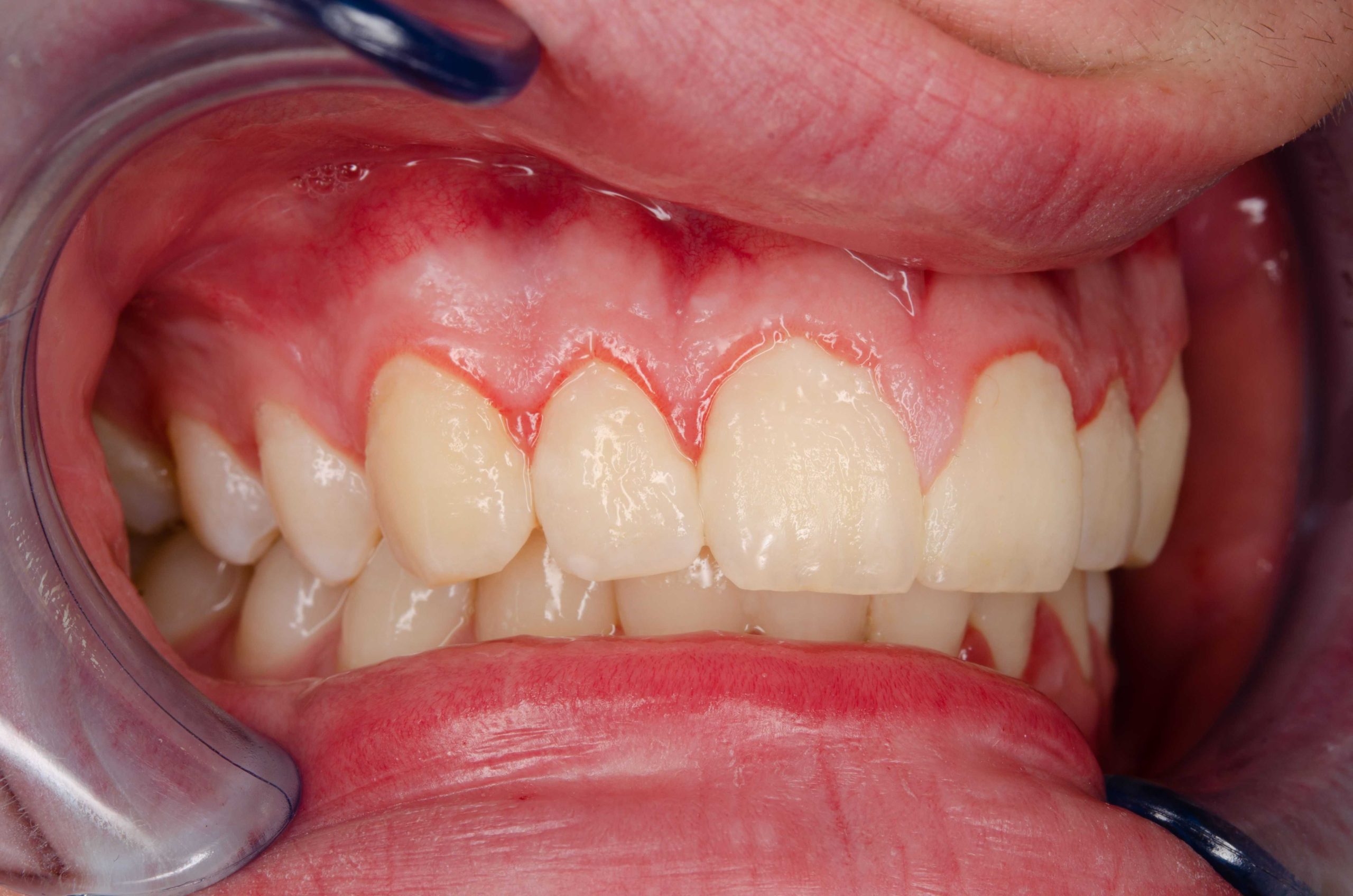 Preventing Plaque & Tartar as well as Harmful Bacteria from the Mouth