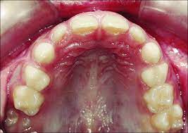A simple guide to know everything about molar bands